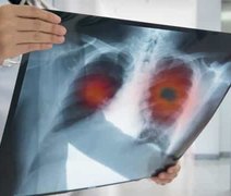 Tipo raro de hipertensão pulmonar pode levar à morte se não for tratado