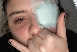 Jovem tem córnea queimada após olhos serem atingidos por 'loló' em festa