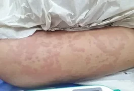 Exame aponta que detergente Ypê não causou doença em menina de 10 anos