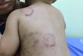 Bebê é hospitalizado com marcas de mordida e mãe depõe à polícia no AM