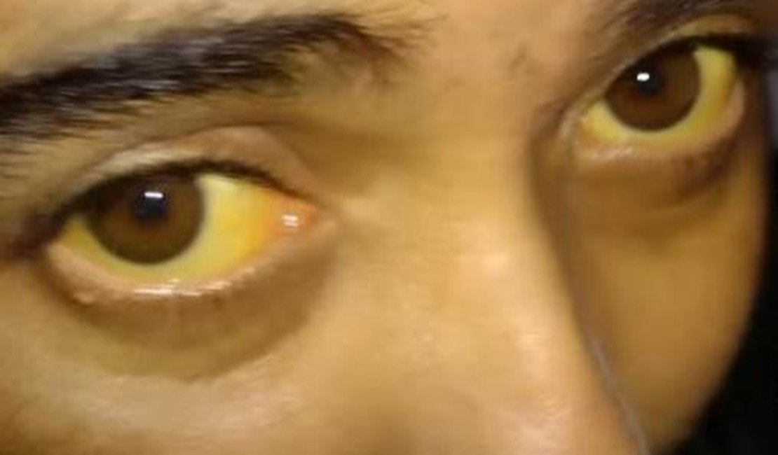 Arapiraquense com doenças que deixam os olhos amarelos e o corpo com marcas precisa fazer cirurgia