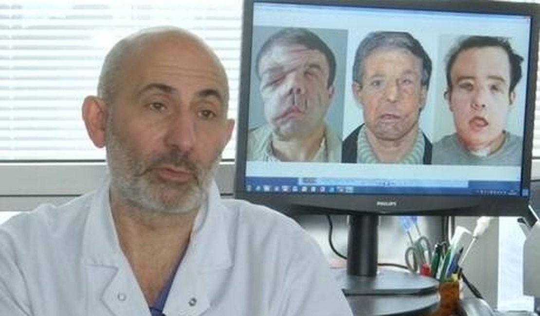 Com doença genética, 'homem de três rostos' faz transplante facial inédito no mundo