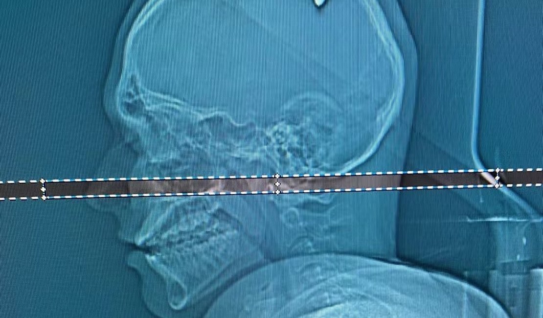 Estudante é atingido por bala perdida na cabeça e só descobre 4 dias depois