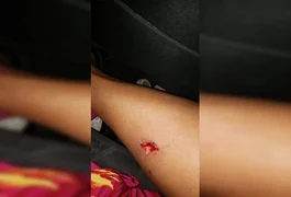 Por rixa antiga, mulher arranca pedaço da perna de rival com dentada: 'Vagabunda, acabou com minha vida na internet'