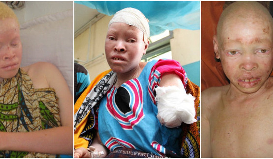 Albinos são cruelmente mutilados e partes do corpo são usadas em 'poções mágicas'