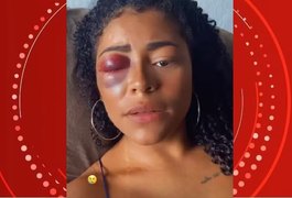 Mulher grava vídeo com olho roxo e denuncia namorado por agressão