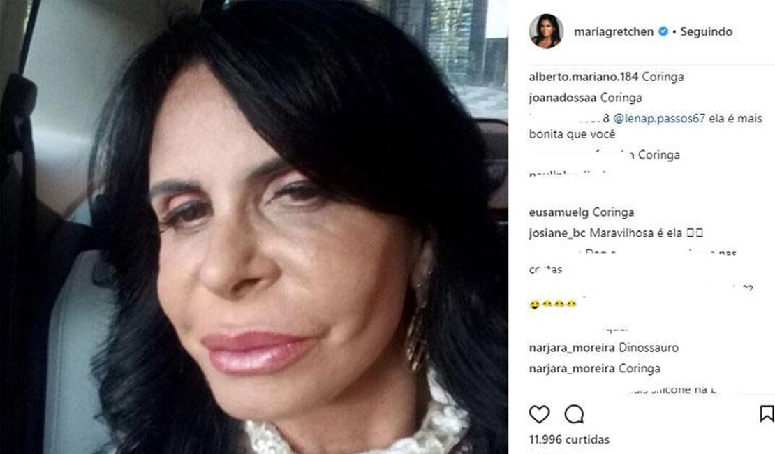Gretchen faz preenchimento labial e web não perdoa: 'Coringa'