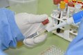 Com 7 casos este ano em Alagoas, Sesau reforça medidas de prevenção contra meningite