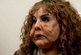 Transexual tem rosto deformado após injetar 'cimento' e implora ajuda