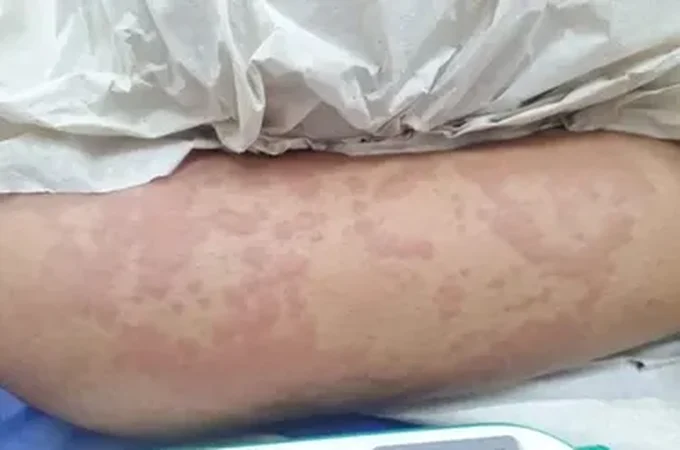 Exame aponta que detergente Ypê não causou doença em menina de 10 anos