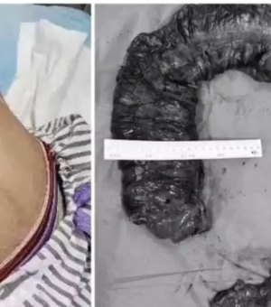 Médicos tiram cocô de 20 kg de intestino de mulher que ficou 10 dias sem evacuar