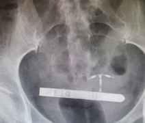 VÍDEO. Mulher passa por cirurgia de emergência para retirar vibrador alojado na bexiga