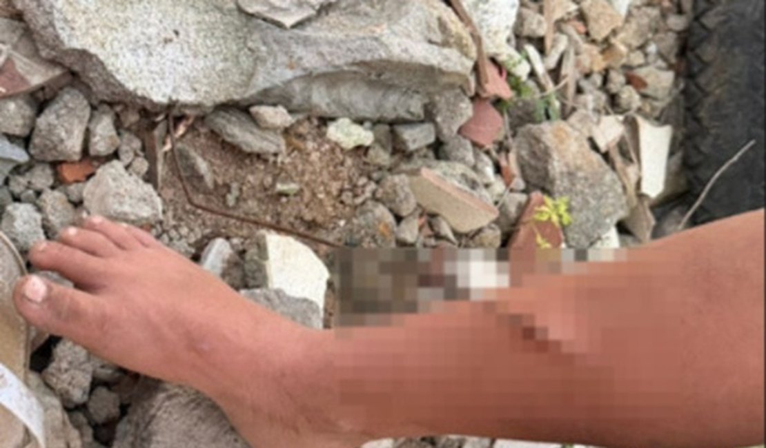 Criança tem perna perfurada por vergalhão enquanto buscava madeira para fogueira, em Arapiraca