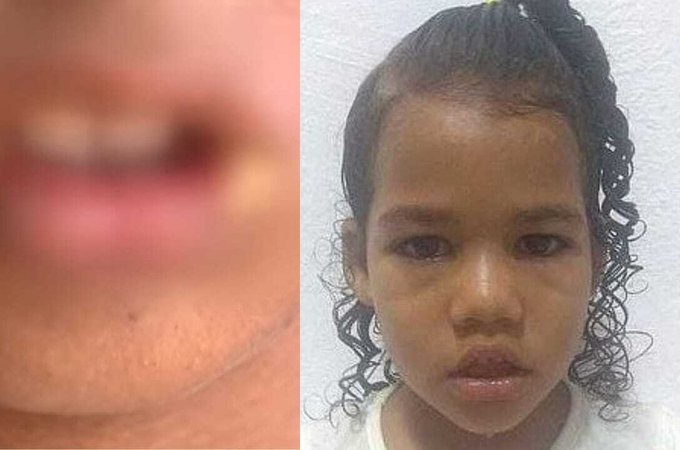 Menino que teve a boca queimada com ovo cozido quente é irmão de menina desaparecida desde 2021