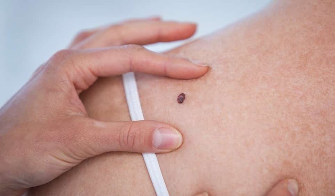 Dezembro Laranja: câncer de pele representa cerca de 30% dos tumores malignos no Brasil