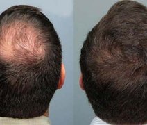 Cientistas descobrem uma nova fórmula que cura queda de cabelo