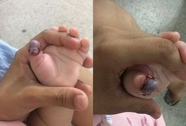 Família afirma que bebê pode ter dedo amputado após esperar três dias por cirurgia
