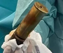 Idoso coloca bomba da Segunda Guerra no ânus e faz hospital inteiro ser evacuado