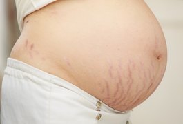 Coçar a barriga na gravidez causa mesmo estria?