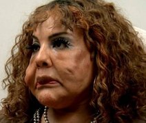Transexual tem rosto deformado após injetar 'cimento' e implora ajuda
