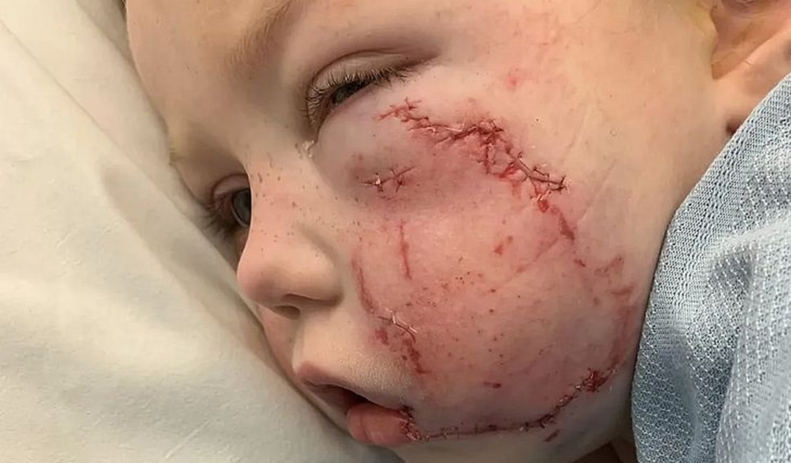 Menina de 4 anos leva mais de 40 pontos no rosto por mordida de cachorro