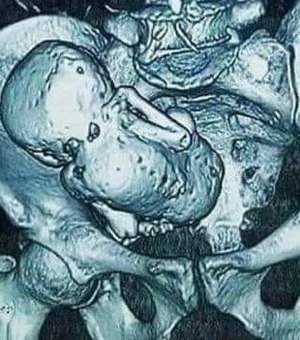 Mulher morre após passar por cirurgia para remover feto calcificado por 56 anos
