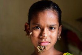 Garota de Bangladesh pode ser a primeira mulher a ter a 'síndrome do homem árvore'