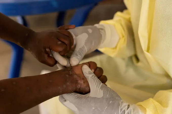 Sobe para 140 número de casos confirmados de Mpox no país, em 2026
