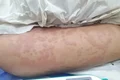 Exame aponta que detergente Ypê não causou doença em menina de 10 anos