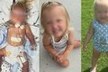 Menina de 18 meses tem as duas pernas amputadas por ter nascido sem um órgão