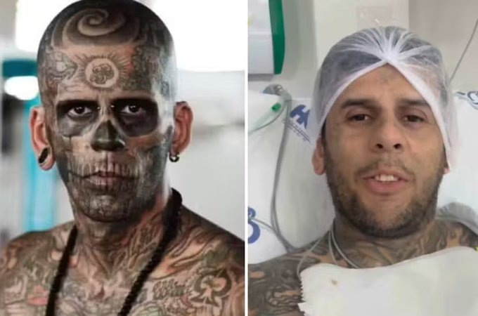 Câncer de bexiga invasivo: entenda tratamento e prognóstico de doença que atinge ‘homem mais tatuado do Brasil’