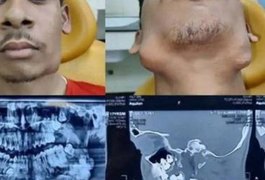 Jovem de 17 anos faz cirurgia para retirar 82 dentes extras