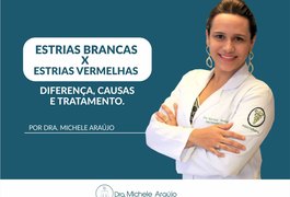 Estrias Brancas X Estrias Vermelhas: Diferenças, causas e tratamentos