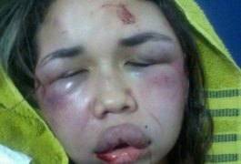 Após ser agredida durante assalto, jovem fica com o rosto desfigurado