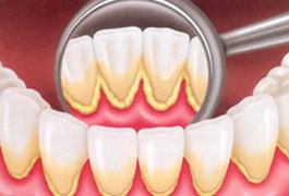 Saiba o que é e como evitar o 'Cálculo dental'