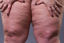 Lipedema é considerada uma doença crônica e afeta principalmente mulheres