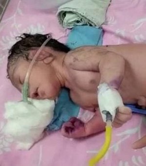 Raro: ‘bebê-sereia’ nasce na Índia com 'cauda' e atrai multidão a hospital
