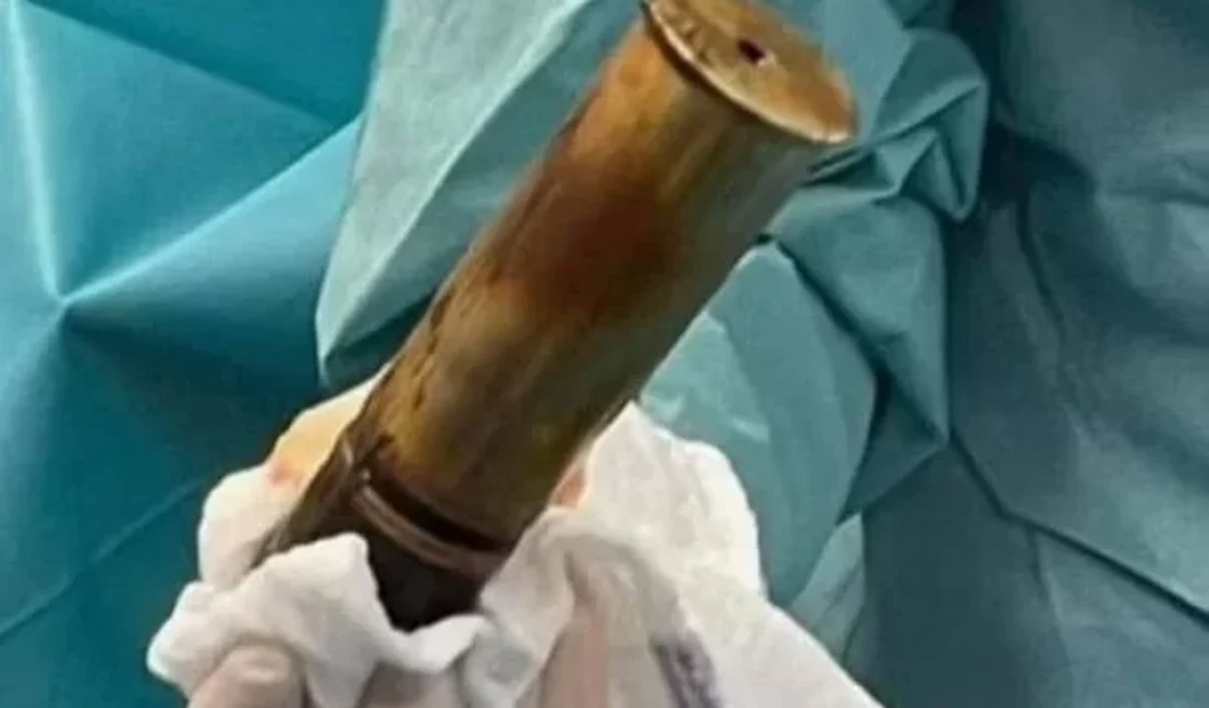 Idoso coloca bomba da Segunda Guerra no ânus e faz hospital inteiro ser evacuado