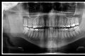 Corpo de enfermeiro do Mato Grosso é identificado por exames odontológicos do IML de Maceió