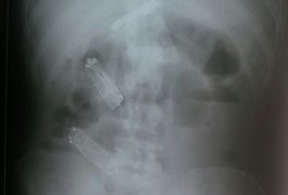 Preso morre após passar mais de uma semana com três celulares no estômago