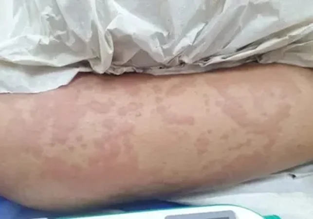 Exame aponta que detergente Ypê não causou doença em menina de 10 anos