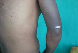 Jovem lança ‘desafio’ e ateia fogo ao próprio corpo no interior de AL