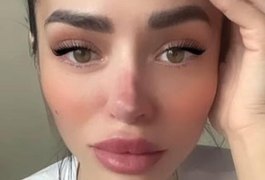 Arrependida, influencer pede ajuda para salvar nariz “apodrecendo” por causa de plástica malsucedida