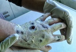 Krokodil: A nova droga mortal que come a carne