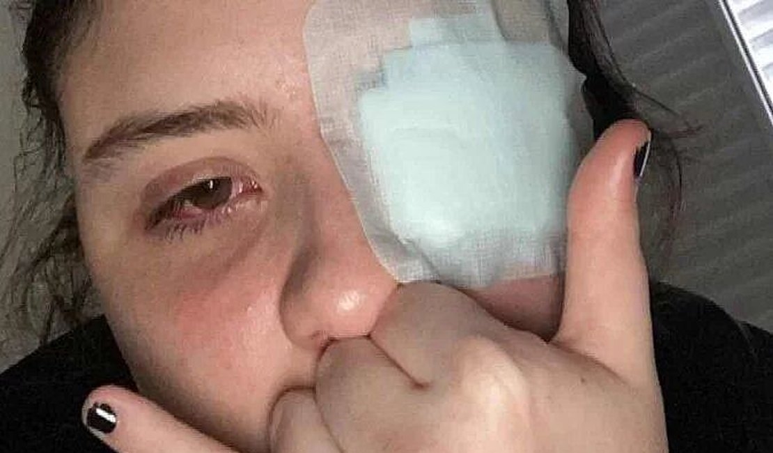 Jovem tem córnea queimada após olhos serem atingidos por 'loló' em festa