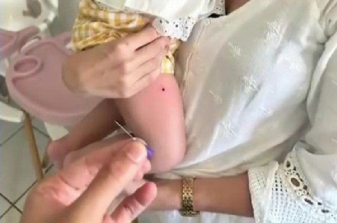 Agulha é deixada na perna de criança durante vacinação em Maceió