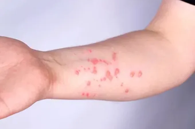 OMS alerta sobre nova variante da mpox e falha do antiviral