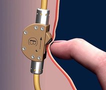 Alemão cria dispositivo contraceptivo masculino