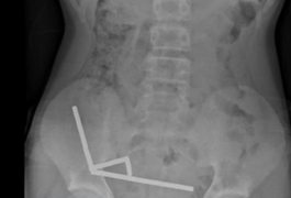 Menino de 13 anos perde parte do intestino após engolir mais de 80 ímãs