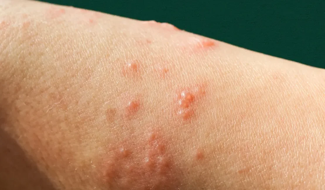 Mpox: nova recombinação de cepas é identificada pela OMS